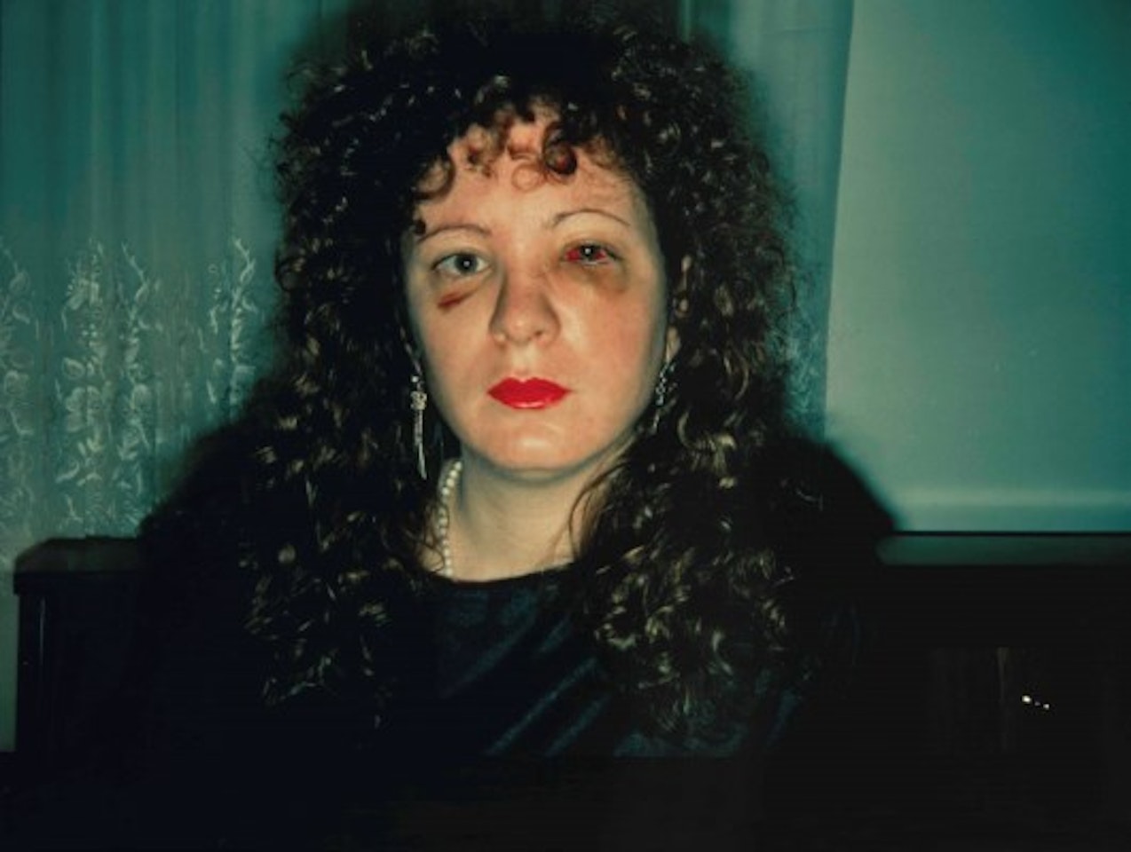 Nan One Month After Being Battered by Nan Goldin