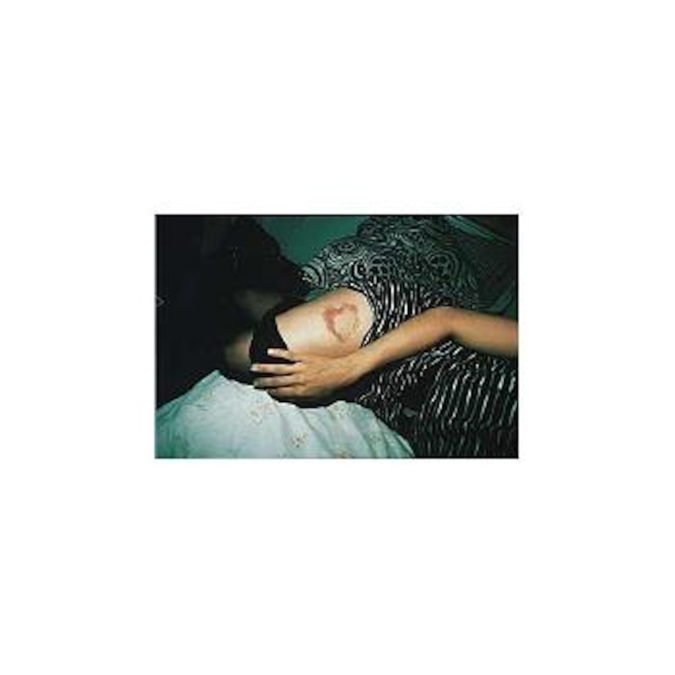 Heart shaped bruise by Nan Goldin