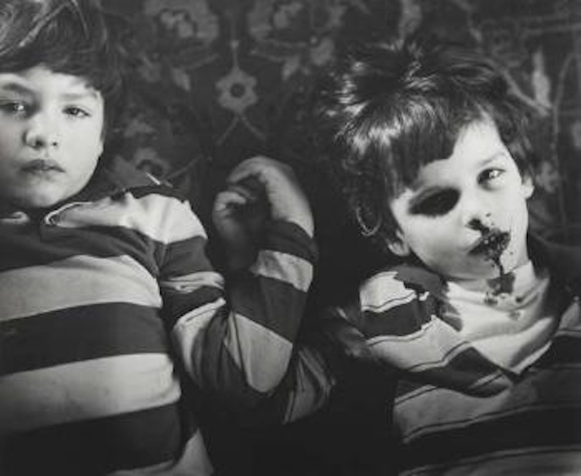 Emmet's Bloody Nose by Sally Mann