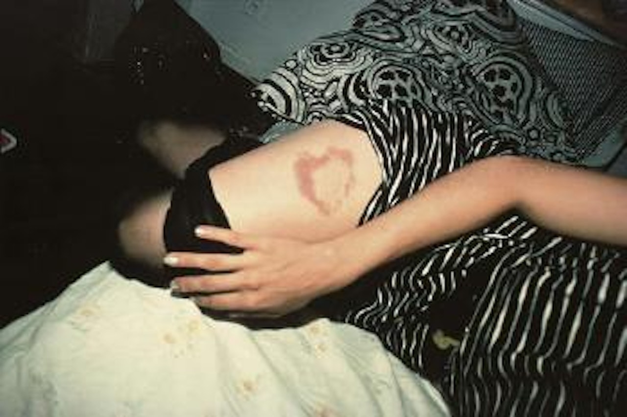 Heart-Shaped Bruise, NYC by Nan Goldin