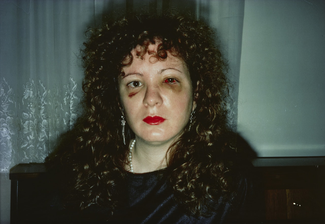 Nan after being battered by Nan Goldin