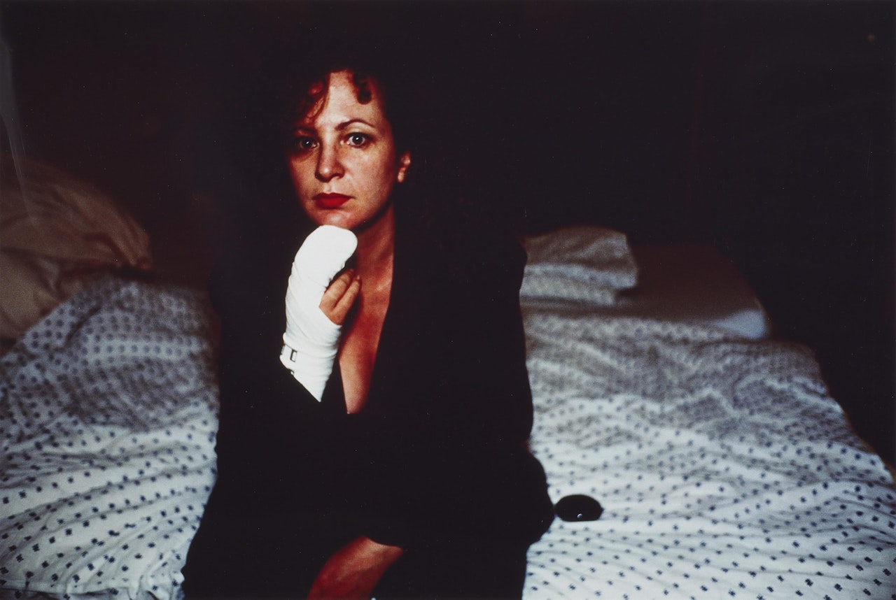 Selfportrait after Finger Operation, Berlin by Nan Goldin