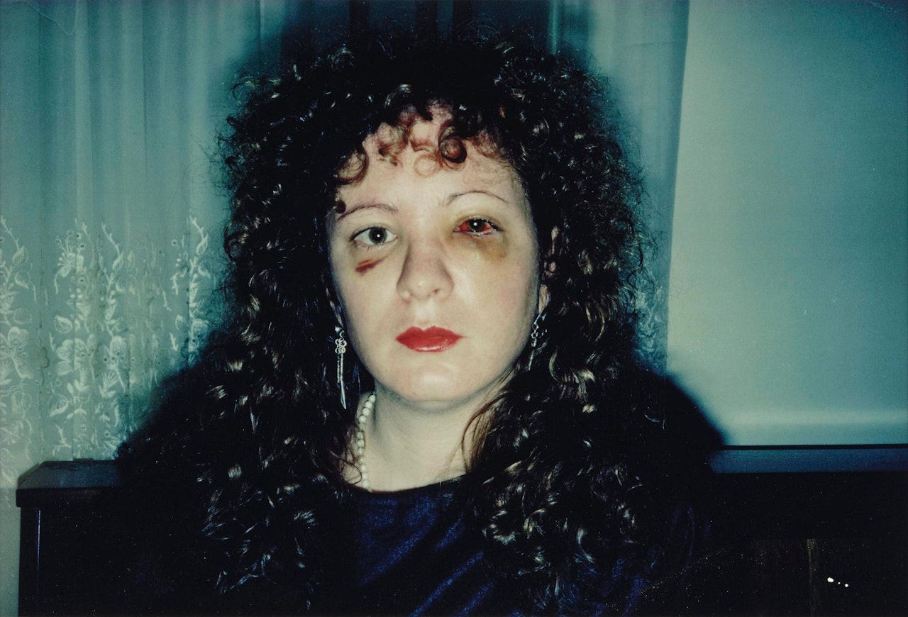 "Nan, One Month After Being Battered" by Nan Goldin